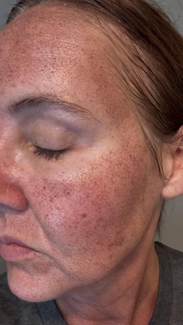 Here’s a look 24 hours after our BBL + HALO stack! ✨ Check back throughout the week to watch the healing process and see her transformation! 

Call us at (541)683-3238 to book your appointment or go online using the link in our bio / store.jewellaestheticmedspa.com! 💖 

“A Reputation Built on Results” 🩷💚
#jewellaestheticmedspaeugeneoregon #hillaryjewellnpeugeneoregon #eugene #eugeneoregon #medspaeugeneoregon #medspa #hydrafacial #botox #dysport #juvederm #skincare #halo #bblforeveryoung #sciton #bbl #sofwave #skintightening #skinfirming #obagiskincare #skinmedica #injectables #skintexture #skinmedica #obagi #restylane #skincare #JAMS #lipfiller #laserhairremoval