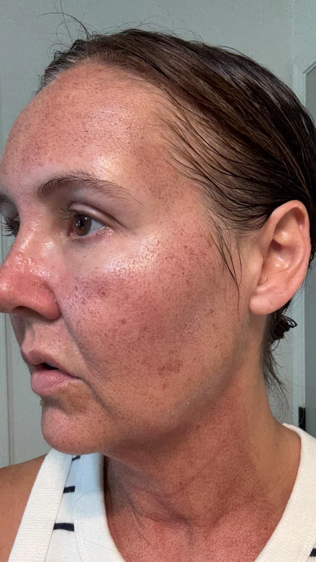 Morning 2 of our beautiful patient’s recovery from the BBL + HALO stack and ealing wonderfully!🌸 The mends have surfaced and will naturally slough off soon! 

Call us at (541)683-3238 to book your appointment or go online using the link in our bio / store.jewellaestheticmedspa.com! 💖 

“A Reputation Built on Results” 🩷💚
#jewellaestheticmedspaeugeneoregon #hillaryjewellnpeugeneoregon #eugene #eugeneoregon #medspaeugeneoregon #medspa #hydrafacial #botox #dysport #juvederm #skincare #halo #bblforeveryoung #sciton #bbl #sofwave #skintightening #skinfirming #obagiskincare #skinmedica #injectables #skintexture #skinmedica #obagi #restylane #skincare #JAMS #lipfiller #laserhairremoval