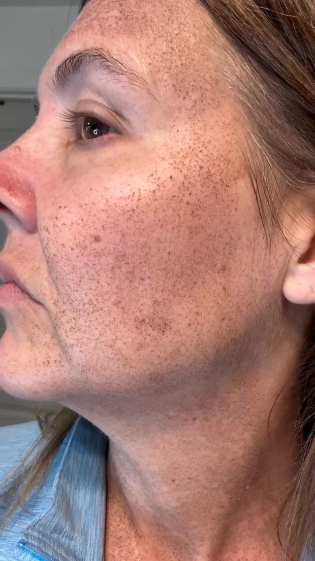 It’s day 6 of our BBL + HALO stack! ✨ The mends are still flaking off, swelling has gone down, and we’re patiently waiting for those incredible results to come!

Call us at (541)683-3238 to book your appointment or go online using the link in our bio / store.jewellaestheticmedspa.com! 💖 

“A Reputation Built on Results” 🩷💚
#jewellaestheticmedspaeugeneoregon #hillaryjewellnpeugeneoregon #eugene #eugeneoregon #medspaeugeneoregon #medspa #hydrafacial #botox #dysport #juvederm #skincare #halo #bblforeveryoung #sciton #bbl #sofwave #skintightening #skinfirming #obagiskincare #skinmedica #injectables #skintexture #skinmedica #obagi #restylane #skincare #JAMS #lipfiller #laserhairremoval