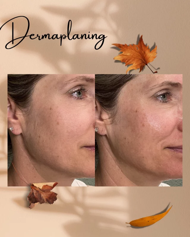 Ever wondered if adding dermaplaning to your HydraFacial is worth it?
Here’s your reminder to say goodbye to peach fuzz and hello to smoother, cleaner, glowing skin! ✨Plus, you can get a package of 4 and save 20% or pair it with many other lasers!

Take your HydraFacial to the next level and feel the difference. Call us at (541)683-3238 to book your appointment or go online using the link in our bio / store.jewellaestheticmedspa.com! 💖 

“A Reputation Built on Results” 🩷💚
#jewellaestheticmedspaeugeneoregon #hillaryjewellnpeugeneoregon #eugene #eugeneoregon #medspaeugeneoregon #medspa #hydrafacial #botox #dysport #juvederm #skincare #halo #bblforeveryoung #sciton #bbl #sofwave #skintightening #skinfirming #obagiskincare #skinmedica #injectables #skintexture #skinmedica #obagi #restylane #skincare #JAMS #lipfiller #laserhairremoval
