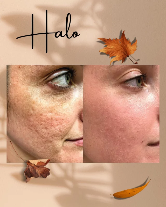 More incredible results from the HALO Laser! ✨Don’t forget, today is the last day all laser packages are 20% OFF!

Call us at (541)683-3238 to book your appointment or go online using the link in our bio / store.jewellaestheticmedspa.com! 💖 

“A Reputation Built on Results” 🩷💚
#jewellaestheticmedspaeugeneoregon #hillaryjewellnpeugeneoregon #eugene #eugeneoregon #medspaeugeneoregon #medspa #hydrafacial #botox #dysport #juvederm #skincare #halo #bblforeveryoung #sciton #bbl #sofwave #skintightening #skinfirming #obagiskincare #skinmedica #injectables #skintexture #skinmedica #obagi #restylane #skincare #JAMS #lipfiller #laserhairremoval