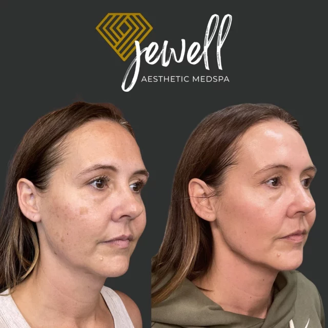 1 month post HALO + BBL treatment 🌟
Look at these stunning before & afters! From faded sun spots to brighter, even skin tone, and noticeably smoother texture. This powerhouse combo works below the surface to stimulate collagen, refine pores, and reveal healthier skin over time.

Call us at (541)683-3238 to book your free consultation or go online using the link in our bio / store.jewellaestheticmedspa.com! 💖 

“A Reputation Built on Results” 🩷💚
#jewellaestheticmedspaeugeneoregon #hillaryjewellnpeugeneoregon #eugene #eugeneoregon #medspaeugeneoregon #medspa #hydrafacial #botox #dysport #juvederm #skincare #halo #bblforeveryoung #sciton #bbl #sofwave #skintightening #skinfirming #obagiskincare #skinmedica #injectables #skintexture #skinmedica #obagi #restylane #skincare #JAMS #lipfiller #laserhairremoval
