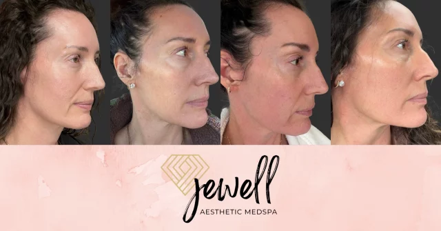 Welcome to Moxi Monday! Here are some photos of our new MOXI machine in action!
Here are photos of before, day 2, day 3, and day 5 to see the healing process and skin progression. This was a base-level 1 MOXI treatment with minimal downtime! 

Call us at (541)683-3238 to book your appointment or go online using the link in our bio / store.jewellaestheticmedspa.com! 💖 

“A Reputation Built on Results” 🩷💚
#jewellaestheticmedspaeugeneoregon #hillaryjewellnpeugeneoregon #eugene #eugeneoregon #medspaeugeneoregon #medspa #hydrafacial #botox #dysport #juvederm #skincare #halo #bblforeveryoung #sciton #bbl #sofwave #skintightening #skinfirming #obagiskincare #skinmedica #injectables #skintexture #skinmedica #obagi #restylane #skincare #JAMS #lipfiller #laserhairremoval