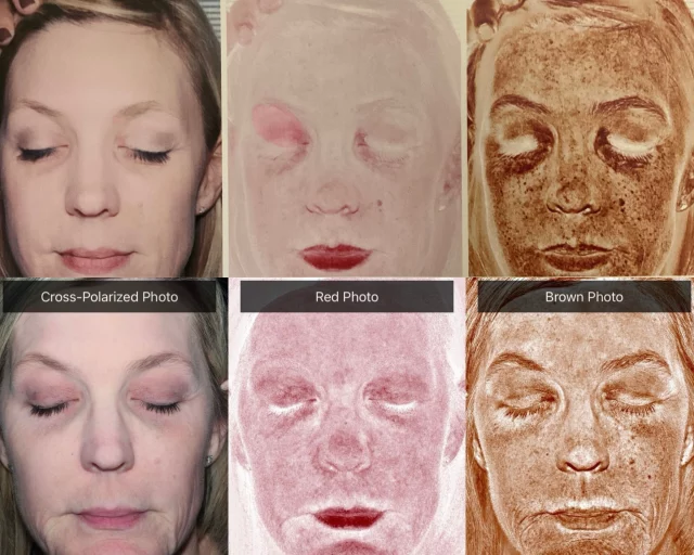 It’s Skin Assessment Day! ✨Here’s the proof that skincare and lasers WORK. Take a look at Stacy’s Reveal Camera results from October 2015 → February 2026 👏
We still have a few spots open this afternoon, call now to secure one of the last appointments and create your own skincare plan! (Plus the quality of the new camera speaks for itself!)

“A Reputation Built on Results” 🩷💚
#jewellaestheticmedspaeugeneoregon #hillaryjewellnpeugeneoregon #eugene #eugeneoregon #medspaeugeneoregon #medspa #hydrafacial #botox #dysport #juvederm #skincare #halo #bblforeveryoung #sciton #bbl #sofwave #skintightening #skinfirming #obagiskincare #skinmedica #injectables #skintexture #skinmedica #obagi #restylane #skincare #JAMS #lipfiller #laserhairremoval
