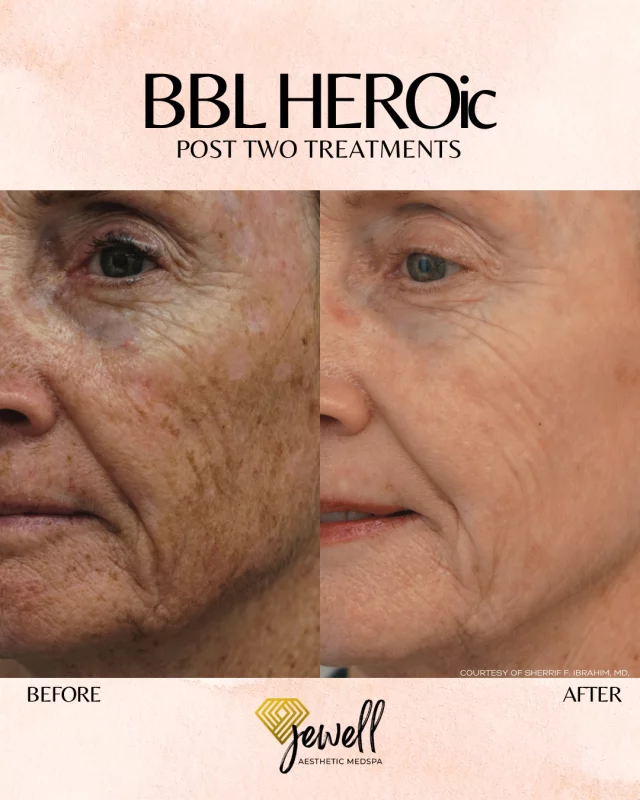 Treat Yourself Tuesday! ✨
Check out these stunning before & after results from BBL Heroic. This advanced treatment helps target unwanted browns and reds, revealing a clearer, more even complexion with little to no downtime.
Powered by innovative light technology from Sciton, BBL works beneath the surface to correct sun damage, redness, and signs of aging 💛

Call us at (541)683-3238 to book your appointment or go online using the link in our bio / store.jewellaestheticmedspa.com! 💖 

“A Reputation Built on Results” 🩷💚
#jewellaestheticmedspaeugeneoregon #hillaryjewellnpeugeneoregon #eugene #eugeneoregon #medspaeugeneoregon #medspa #hydrafacial #botox #dysport #juvederm #skincare #halo #bblforeveryoung #sciton #bbl #sofwave #skintightening #skinfirming #obagiskincare #skinmedica #injectables #skintexture #skinmedica #obagi #restylane #skincare #JAMS #lipfiller #laserhairremoval