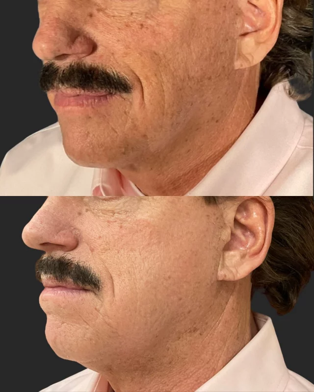 It’s Transformation Thursday! 
No one does transformations like Jaclyn, Our Laser Guru! 🔥 As an advanced esthetician, she’s been performing Halo treatments for over 2 years, delivering stunning results. Just check out these amazing before and afters!

Call us at (541)683-3238 to book your appointment or go online using the link in our bio / store.jewellaestheticmedspa.com! 💖 

“A Reputation Built on Results” 🩷💚
#jewellaestheticmedspaeugeneoregon #hillaryjewellnpeugeneoregon #eugene #eugeneoregon #medspaeugeneoregon #medspa #hydrafacial #botox #dysport #juvederm #skincare #halo #bblforeveryoung #sciton #bbl #sofwave #skintightening #skinfirming #obagiskincare #skinmedica #injectables #skintexture #skinmedica #obagi #restylane #skincare #JAMS #lipfiller #laserhairremoval