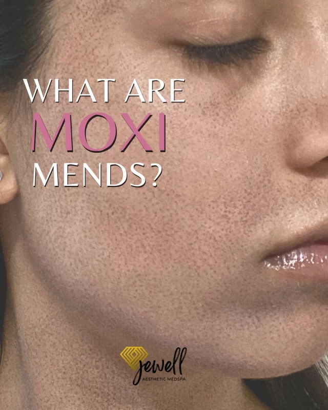Moxi Monday!⚡MENDS (Microscopic Epidermal Necrotic Debris) will appear around the 2nd day after treatment as tiny dark spots that have a sand paper like texture.
MENDS are a part of the healing process where it's out with the old and in with new, regenerated skin. 

Call us at (541)683-3238 to book your appointment or go online using the link in our bio / store.jewellaestheticmedspa.com! 💖 

“A Reputation Built on Results” 🩷💚
#jewellaestheticmedspaeugeneoregon #hillaryjewellnpeugeneoregon #eugene #eugeneoregon #medspaeugeneoregon #medspa #hydrafacial #botox #dysport #juvederm #skincare #halo #bblforeveryoung #sciton #bbl #sofwave #skintightening #skinfirming #obagiskincare #skinmedica #injectables #skintexture #skinmedica #obagi #restylane #skincare #JAMS #lipfiller #laserhairremoval