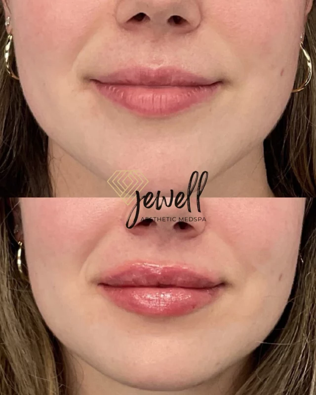 Filler Friday!💋 You don’t always need a full syringe to see a difference. This patient came in with stunning lips but wanted more fullness. This subtle enhancement with half a syringe added definition and fullness while keeping her look completely natural.

Call us at (541)683-3238 to book your appointment or go online using the link in our bio / store.jewellaestheticmedspa.com! 💖 

“A Reputation Built on Results” 🩷💚
#jewellaestheticmedspaeugeneoregon #hillaryjewellnpeugeneoregon #eugene #eugeneoregon #medspaeugeneoregon #medspa #hydrafacial #botox #dysport #juvederm #skincare #halo #bblforeveryoung #sciton #bbl #sofwave #skintightening #skinfirming #obagiskincare #skinmedica #injectables #skintexture #skinmedica #obagi #restylane #skincare #JAMS #lipfiller #laserhairremoval