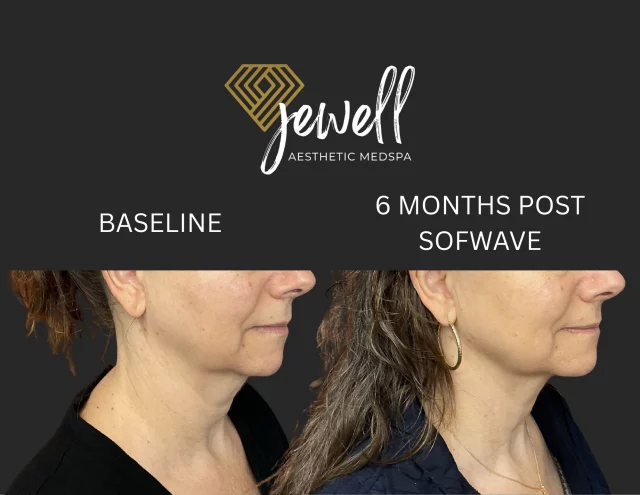 Sofwave Saturday! ✨Check out these Sofwave results just 6 months apart! Sofwave works by stimulating collagen production to tighten and firm the skin over time.
Collagen takes about 6 months to fully regenerate, with optimal results continuing to improve up to 12 months. The best part? We’ve been seeing patients notice visible improvements in as little as 3 months!💛

Call us at (541)683-3238 to book your appointment or go online using the link in our bio / store.jewellaestheticmedspa.com! 💖 

“A Reputation Built on Results” 🩷💚
#jewellaestheticmedspaeugeneoregon #hillaryjewellnpeugeneoregon #eugene #eugeneoregon #medspaeugeneoregon #medspa #hydrafacial #botox #dysport #juvederm #skincare #halo #bblforeveryoung #sciton #bbl #sofwave #skintightening #skinfirming #obagiskincare #skinmedica #injectables #skintexture #skinmedica #obagi #restylane #skincare #JAMS #lipfiller #laserhairremoval