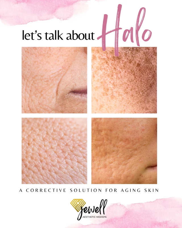 Transformation Thursday! Today we’re highlighting the skin concerns that HALO can treat!✨
HALO is our most aggressive laser, it targets both the surface of the skin and deeper layers at the same time for powerful results. Because it works both superficially and deep within the skin, you get serious collagen stimulation along with dramatic resurfacing! Giving you smoother, clearer, more youthful-looking skin.

If you’re ready for a real transformation, HALO might be your treatment.🔥 Call us at (541)683-3238 to book your appointment or go online using the link in our bio / store.jewellaestheticmedspa.com! 💖 

“A Reputation Built on Results” 🩷💚
#jewellaestheticmedspaeugeneoregon #hillaryjewellnpeugeneoregon #eugene #eugeneoregon #medspaeugeneoregon #medspa #hydrafacial #botox #dysport #juvederm #skincare #halo #bblforeveryoung #sciton #bbl #sofwave #skintightening #skinfirming #obagiskincare #skinmedica #injectables #skintexture #skinmedica #obagi #restylane #skincare #JAMS #lipfiller #laserhairremoval
