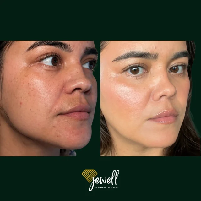 Check out these before & afters from a Clear + Brilliant! This is 4 weeks after her 3rd treatment! This is exactly why our 20% OFF package of 3 is the perfect opportunity to commit to your skin! 💗
Clear + Brilliant is a gentle fractional laser that helps improve skin tone, texture, pores, fine lines, and overall brightness with minimal downtime.

Want to get even more out of your treatment? Pair your Clear + Brilliant with BBL to target both skin texture AND pigmentation/redness! 

To get our biggest sale of the year call us at 541-683-3238 or go online using the link in our bio / store.jewellaestheticmedspa.com! 💖

“A Reputation Built on Results” 🩷💚
#jewellaestheticmedspaeugeneoregon #hillaryjewellnpeugeneoregon #eugene #eugeneoregon #medspaeugeneoregon #medspa #hydrafacial #botox #dysport #juvederm #skincare #halo #bblforeveryoung #sciton #bbl #sofwave #skintightening #skinfirming #obagiskincare #skinmedica #injectables #skintexture #skinmedica #obagi #restylane #skincare #JAMS #lipfiller #laserhairremoval