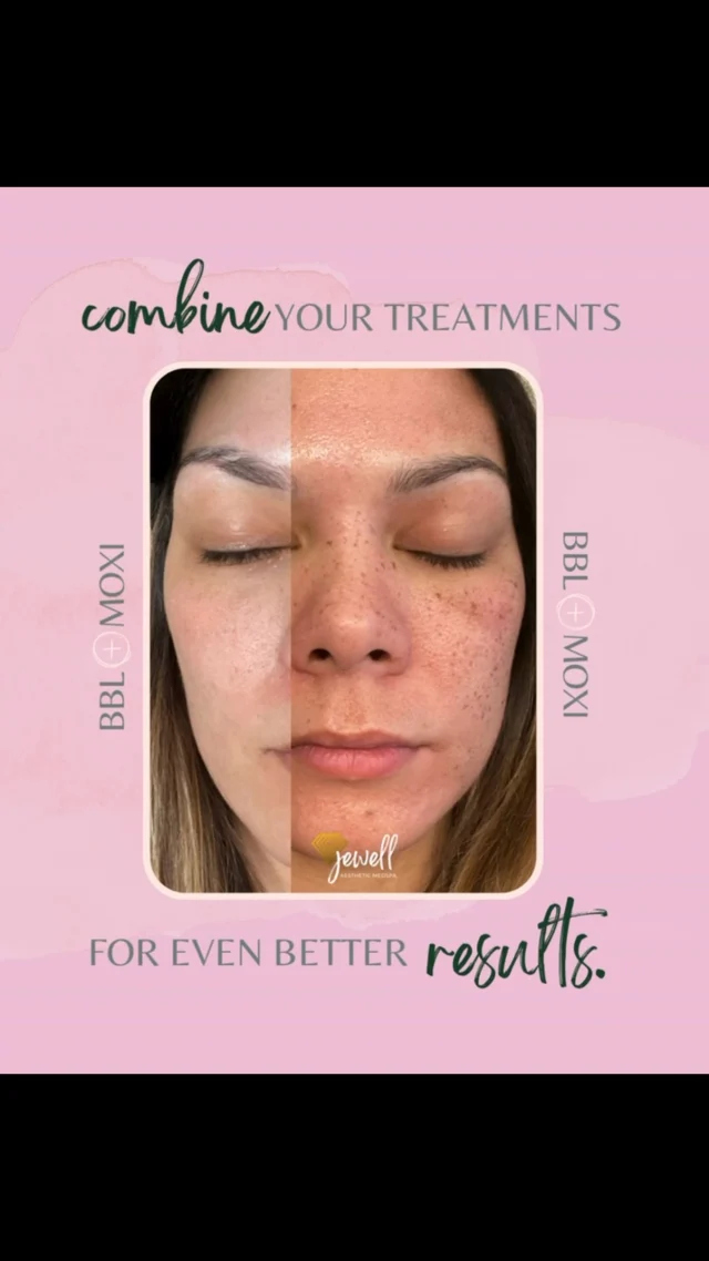 BBL helps target sun damage, redness, and uneven pigmentation, while MOXI works to refine skin tone and texture for that fresh, radiant glow. 💗And right now, you can enjoy 20% OFF a package of 3! 

Call our office at 541-683-3238 or head online using the link in our bio / store.jewellaestheticmedspa.com to snag our biggest sale of the year! 🍂

“A Reputation Built on Results” 🩷💚
#medspaeugene #resultsmatter #lasersale #sciton #jewellaestheticmedspa