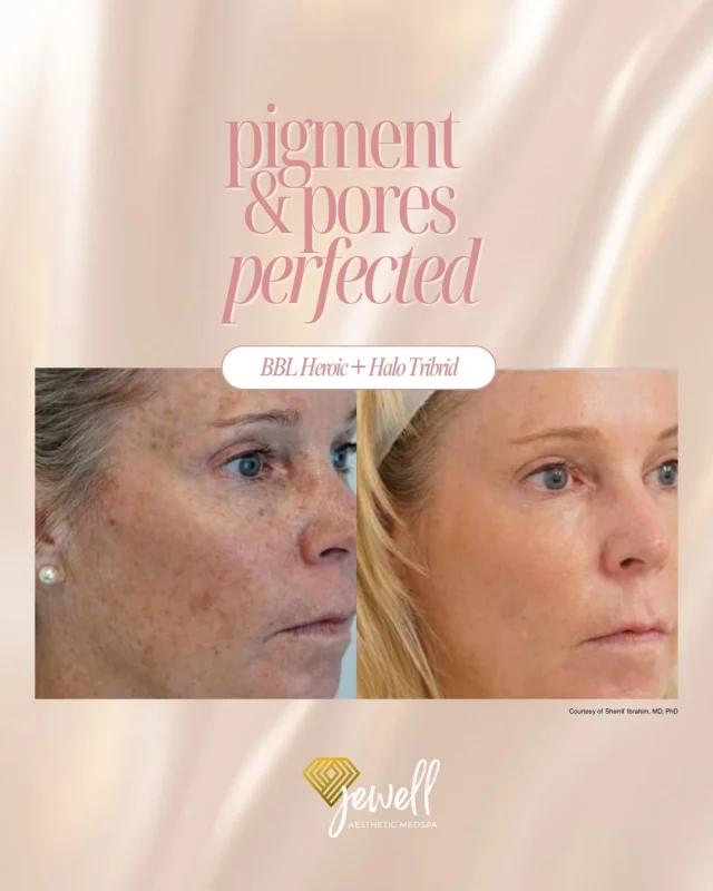 HALO TRIBRID helps refine skin texture, minimize the appearance of pores, and improve overall skin quality, while BBL targets sun damage, redness, and uneven pigmentation. Together, they make the ultimate skin-rejuvenation combo! 💗 Take advantage of our 20% OFF laser packages!

Call our office at 541-683-3238 or head online using the link in our bio / store.jewellaestheticmedspa.com to snag our biggest sale of the year! 🍂

“A Reputation Built on Results” 🩷💚
#medspaeugene #resultsmatter #lasersale #sciton #jewellaestheticmedspa