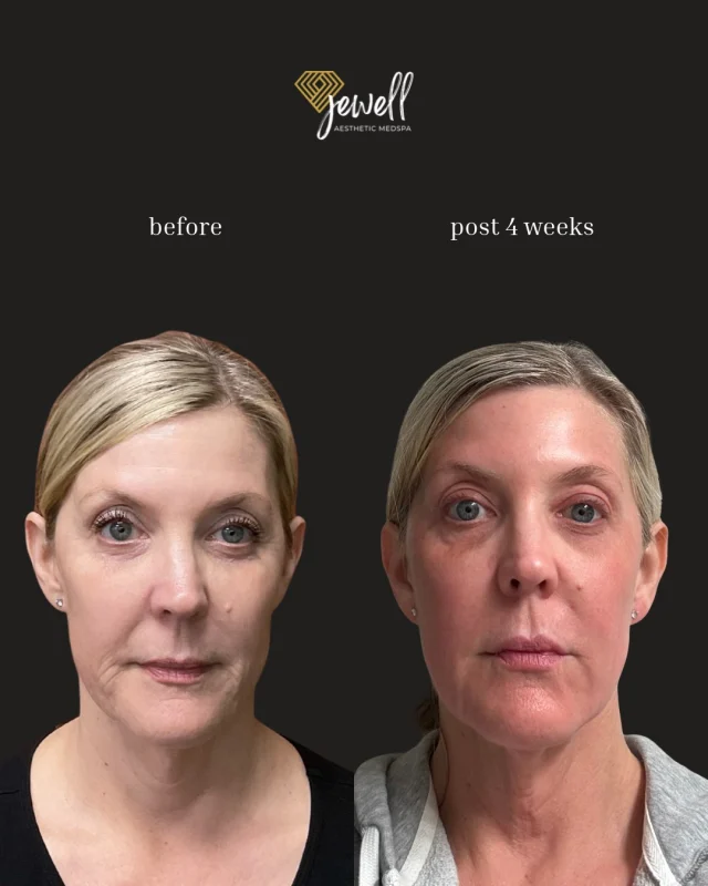 HALO TRIBRID 4 Weeks Post-Treatment! Here is a little update from Stacy herself!
I’m still a little pink at 4 weeks post-treatment, and I’m thrilled with my results! ❤️
No filter. No Botox. No filler. Just laser resurfacing! 🙌 HALO TRIBRID works by stimulating collagen production and improving skin tone, texture, and overall skin quality. My skin is still improving, and I can’t wait to see how my results continue to develop! I’ll share another update in a couple of weeks so you can follow my skin transformation. -Stacy

You can get the same results as Stacy for 20% off until Monday October 26th. Call our office at 541-683-3238 or go online using the link in our bio / store.jewellaestheticmedspa.com ! 💖 

“A Reputation Built on Results” 🩷💚
#resultsmatter #tribrid #halo #halotribrid #jewellaestheticmedspaeugeneoregon #eugene #eugeneoregon #medspaeugeneoregon #medspa #skincare #halo #bblforeveryoung #bbl #sofwave #skintightening #skinfirming #obagiskincare #skinmedica #Moxi #skintexture #skinmedica #obagi #skincare #JAMS #laserhairremoval